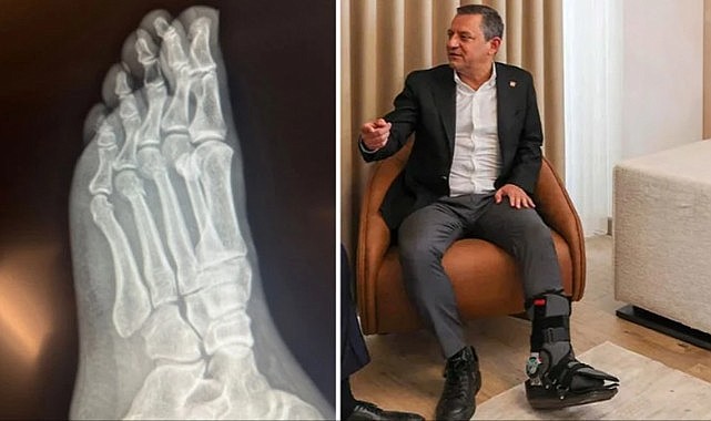 Özgür Özel'den "Vuruldu" iddialarına sert tepki! Ayağındaki kırıkların filmleri yayınlandı