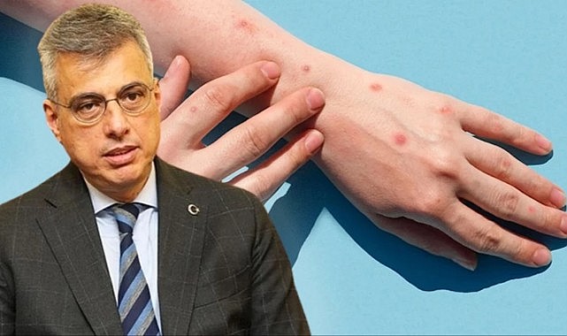 Sağlık Bakanı Memişoğlu'ndan "maymun çiçeği virüsü" açıklaması: Türkiye'de görülmedi